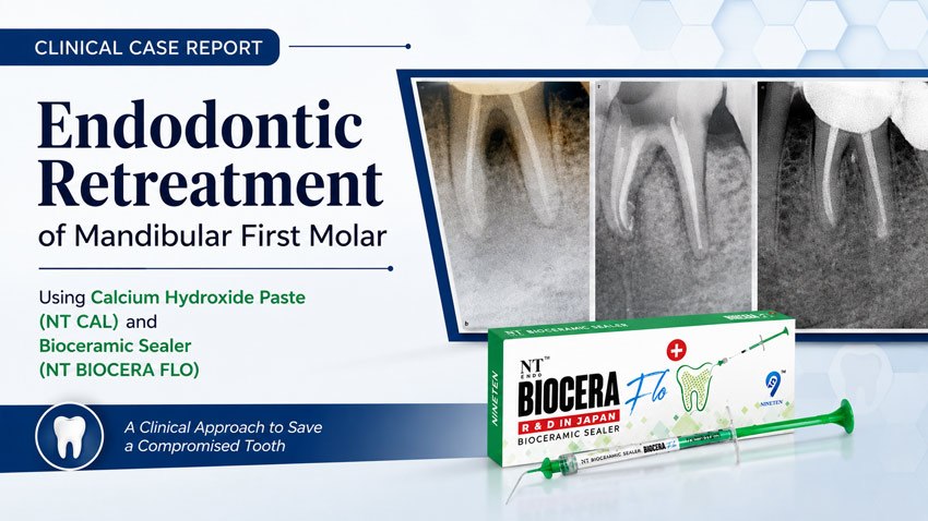Clinical case report of endodontic retreatment of mandibular first molar using NT CAL and NT Biocera Flo plus
