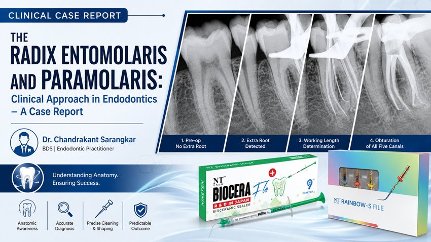 Clinical case report of Radix Entomolaris and Paramolaris showing endodontic treatment and obturation of five root canals